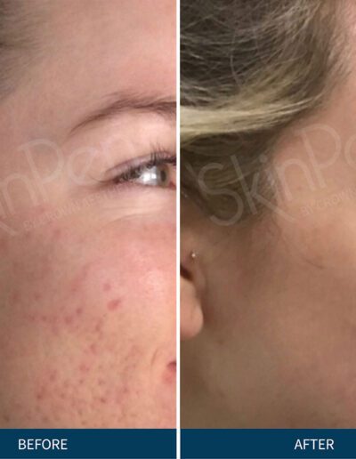 Medical micro needling before and after